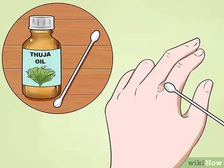 Imagen titulada Get Rid of Warts on Hands Step 8