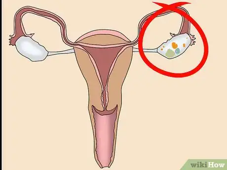 Imagen titulada Know if You Have an Ovarian Cyst Step 12