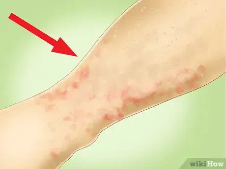 Imagen titulada Treat Pinpoint Petechiae Step 10