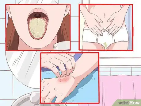 Imagen titulada Stop a Developing Yeast Infection Step 10