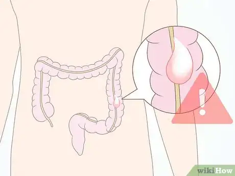 Imagen titulada Avoid Diverticulitis Step 17