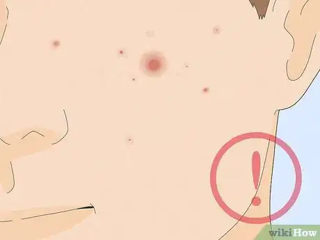 Imagen titulada Pop a Pimple Step 3