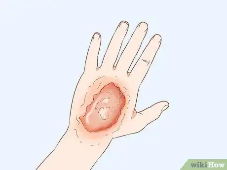 Imagen titulada Get Rid of Poison Ivy Rashes Step 3