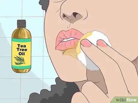 Imagen titulada Treat a Cold Sore or Fever Blisters Step 15