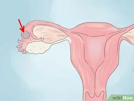 Imagen titulada Treat Blocked Fallopian Tubes Step 12