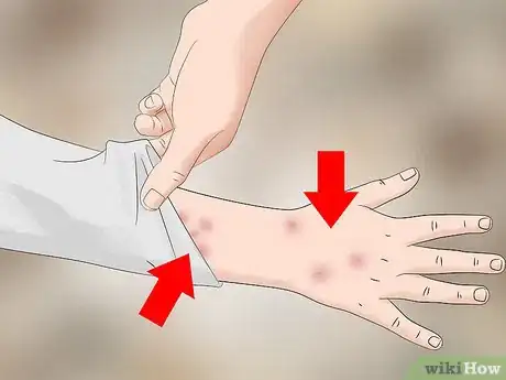 Imagen titulada Identify Bed Bug Bites Step 3