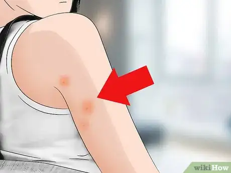 Imagen titulada Identify Bed Bug Bites Step 1