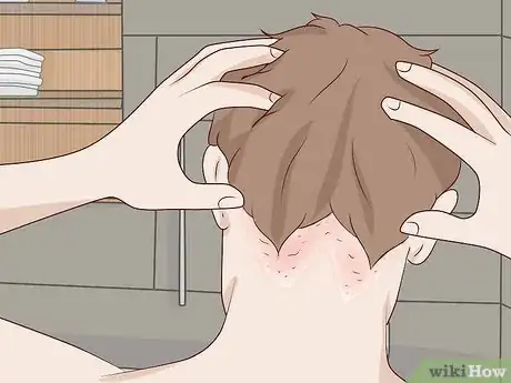 Imagen titulada Get Rid of Dandruff at Home Step 14