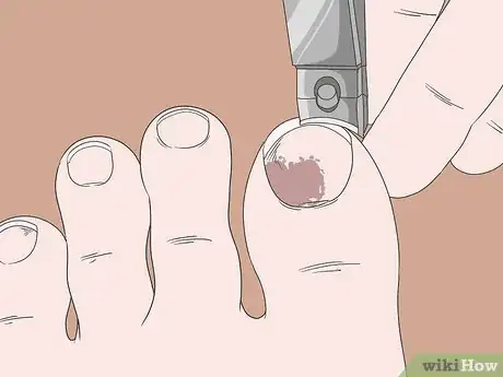 Imagen titulada Heal a Bruised Toe Step 10