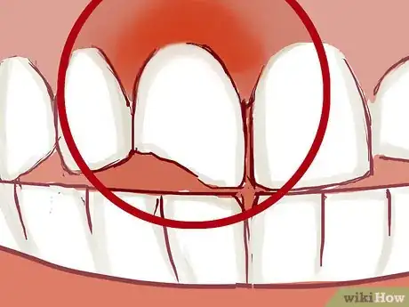 Imagen titulada Treat a Broken Tooth Step 4