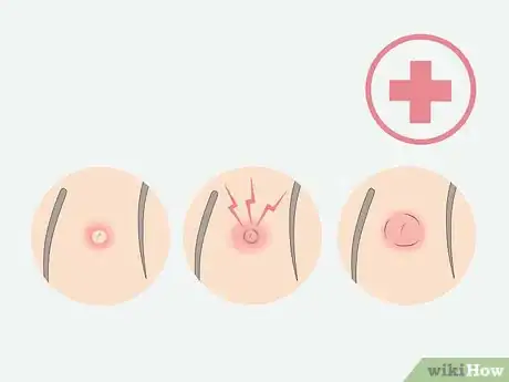 Imagen titulada Get Rid of Ingrown Pubic Hair Step 15