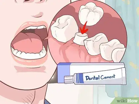 Imagen titulada Fix a Lost Dental Crown Step 1