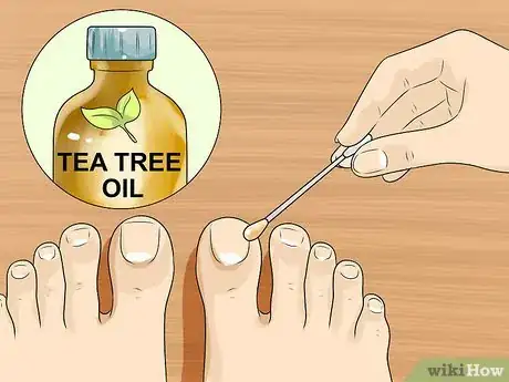 Imagen titulada Cure Toenail Fungus with Vinegar Step 5