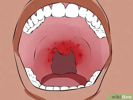 Imagen titulada Recognize Signs of Oral Cancer Step 3