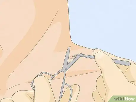 Imagen titulada Remove a Skin Tag from Your Neck Step 2