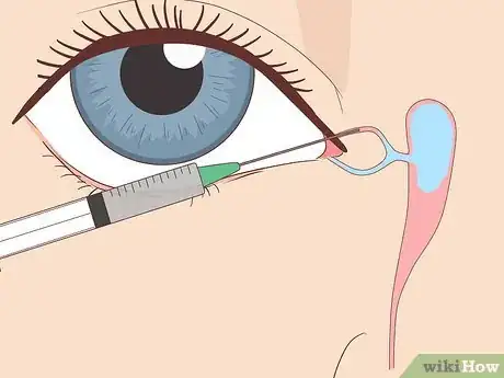 Imagen titulada Clear a Blocked Tear Duct Step 10