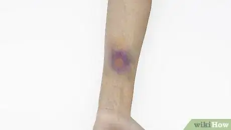 Imagen titulada Make a Fake Bruise Step 1