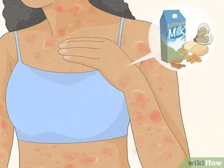 Imagen titulada Recognize Hives (Rash) Step 5