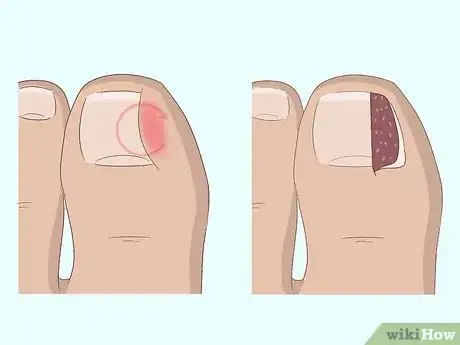Imagen titulada Relieve Ingrown Toe Nail Pain Step 26