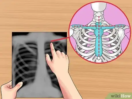 Imagen titulada Read a Chest X Ray Step 6