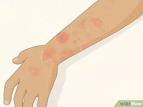 Imagen titulada Recognize Hives (Rash) Step 2