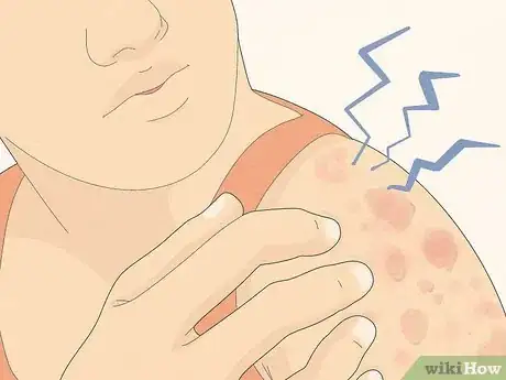 Imagen titulada Recognize Hives (Rash) Step 1