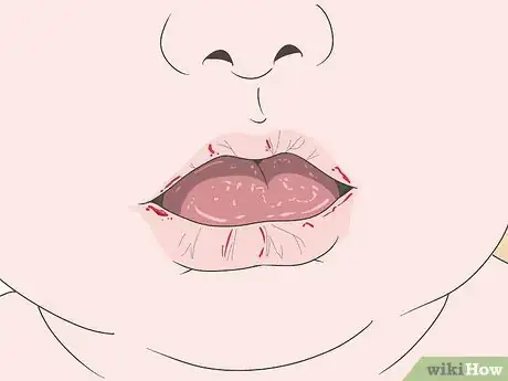 Imagen titulada Know if You Have Oral Thrush Step 3