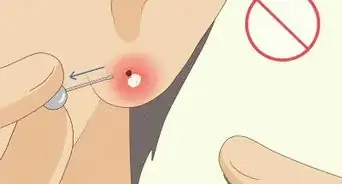 tratar un piercing infectado