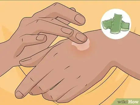 Imagen titulada Treat a Hot Glue Burn Step 12