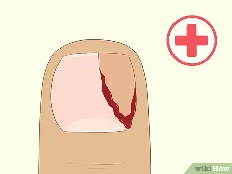 Imagen titulada Heal Damaged Nails Step 5