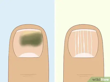 Imagen titulada Heal Damaged Nails Step 1