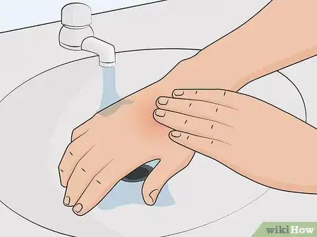 Imagen titulada Treat a Hot Glue Burn Step 11