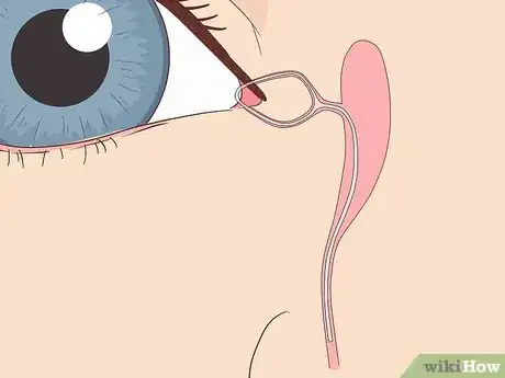 Imagen titulada Clear a Blocked Tear Duct Step 11