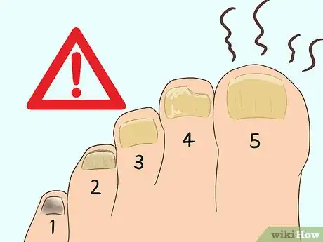 Imagen titulada Treat a Black Toenail Step 8