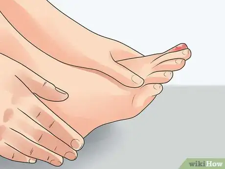 Imagen titulada Treat a Stubbed Toe Step 8