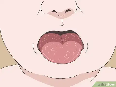 Imagen titulada Know if You Have Oral Thrush Step 5