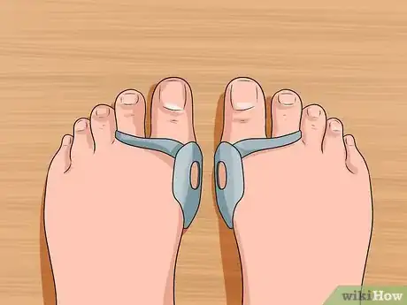 Imagen titulada Get Rid of Bunions Step 5