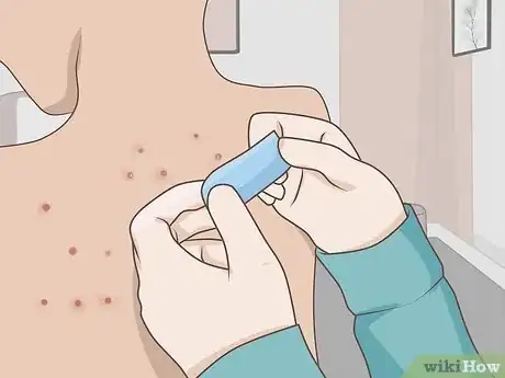 Imagen titulada Treat Chickenpox at Home Step 11