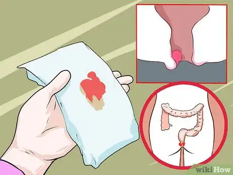 Imagen titulada Treat Hemorrhoids After Pregnancy Step 13