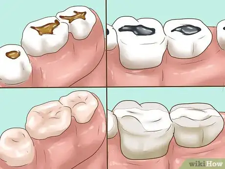 Imagen titulada Know if Your Dental Fillings Need Replacing Step 10