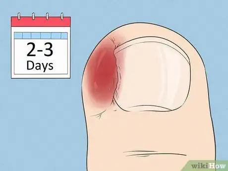 Imagen titulada Will an Ingrown Toenail Heal Itself Step 8