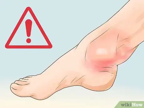 Imagen titulada Cure a Swollen Ankle Step 2