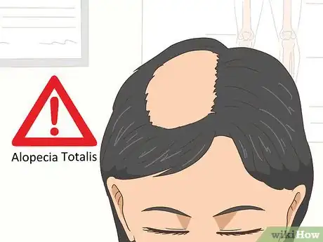 Image intitulée Treat Alopecia Step 13