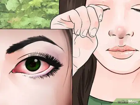 Image intitulée Treat Eye Infection Naturally Step 23