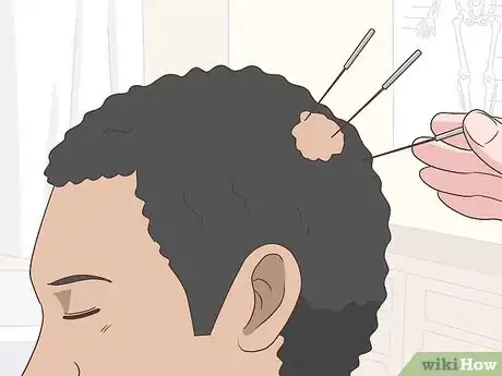 Image intitulée Treat Alopecia Step 10