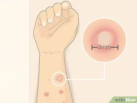 Image intitulée Read Allergy Skin Test Results Step 8