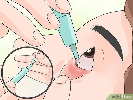 Image intitulée Remove Foreign Objects from the Eye Step 6