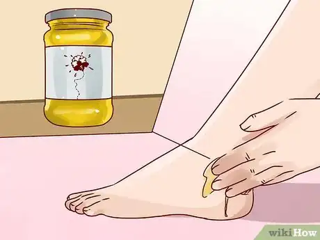 Image intitulée Get Rid of Ringworm Scars Step 5