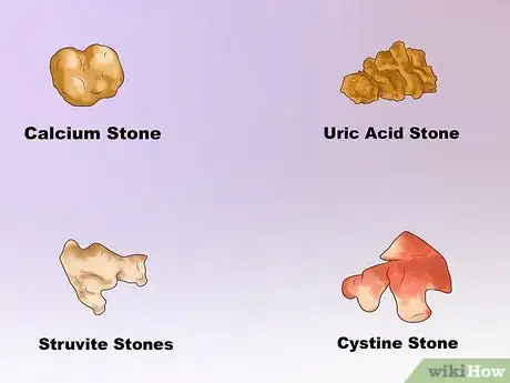 Image intitulée Dissolve Kidney Stones Step 3