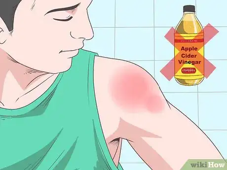 Image intitulée Treat Apple Cider Vinegar Burns Step 12